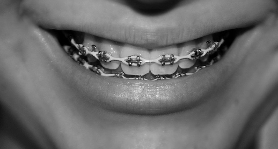 best-family-orthodontics-kids-braces-1b