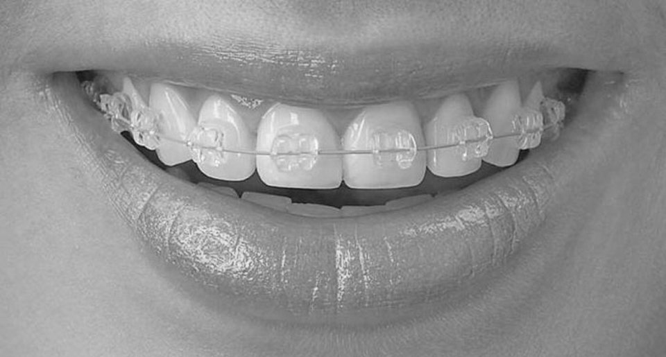 best-orthodontics-braces-nyc-01