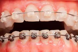 Clear Braces vs. Metal Braces, Frazer Dental Care