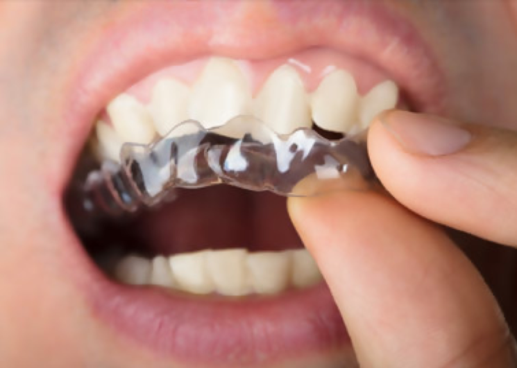 The Form of Braces People May Not Know About: Ceramic Braces
