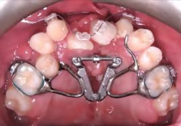 How Braces Work: Different Types of Orthodontics - Vondran Orthodontics