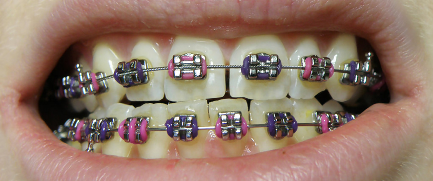 Ceramic Braces in Brooklyn, NY  Invisible Orthodontic Treatment