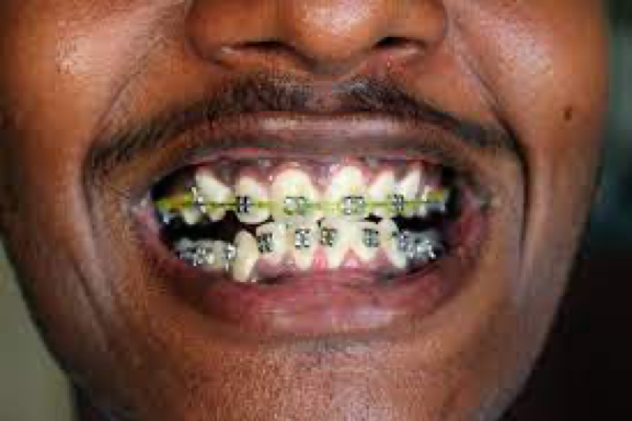 All About Adult Braces - Best Orthodontist NYC